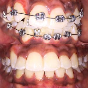 Dental Orthodontic Braces Treatment
