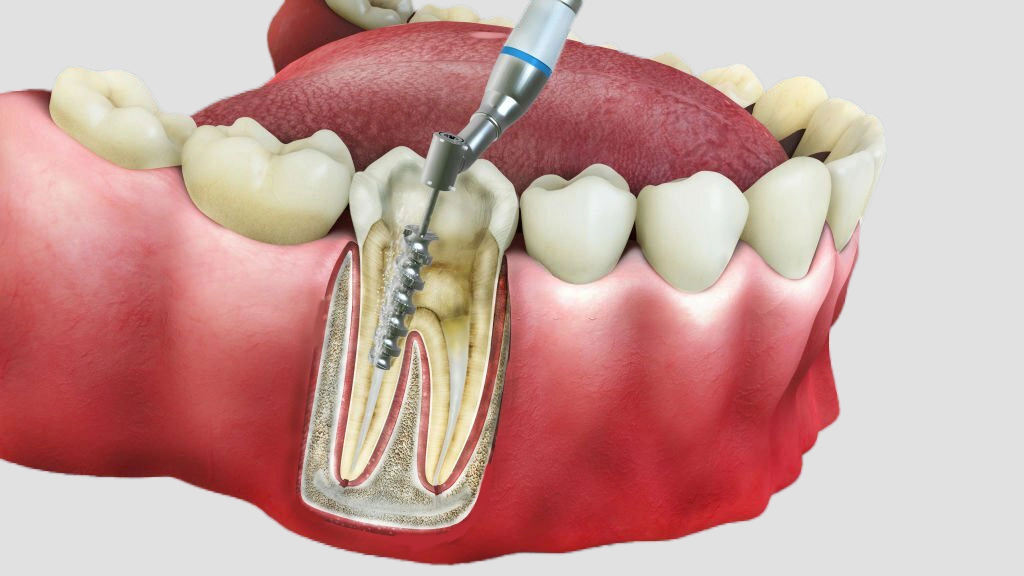 root canal treatment in chennai